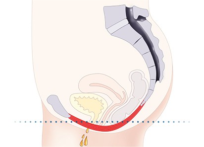 Pelvic-Floor Muscle Repair 5 Pelvic floor muscles Horsham