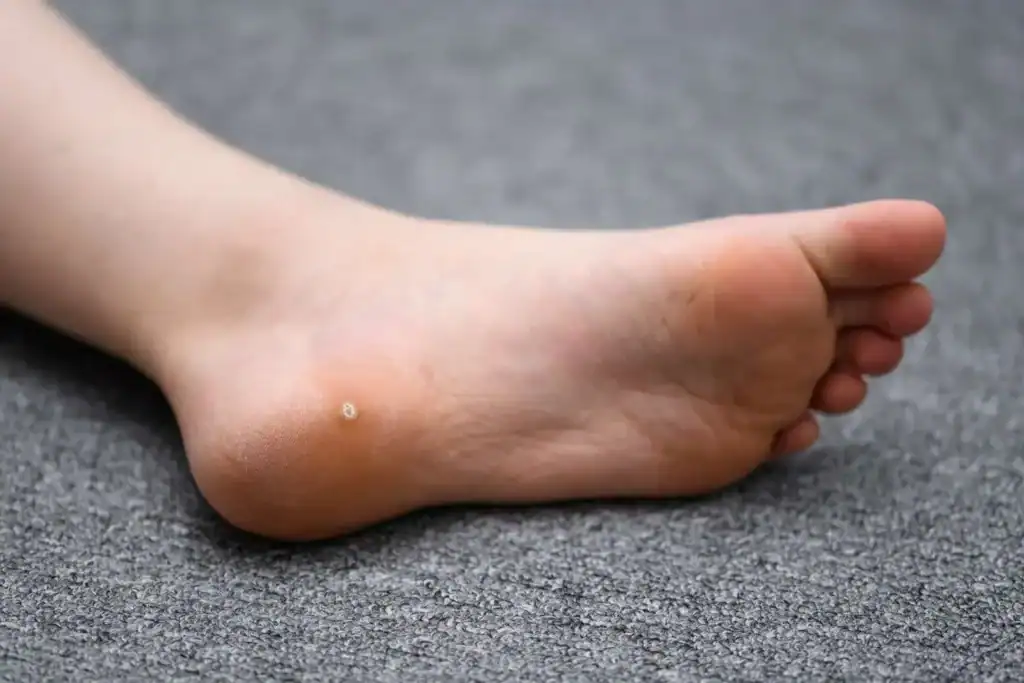 Image of verruca on the bottom of the foot that able to be treated with Cryotherapy Horsham