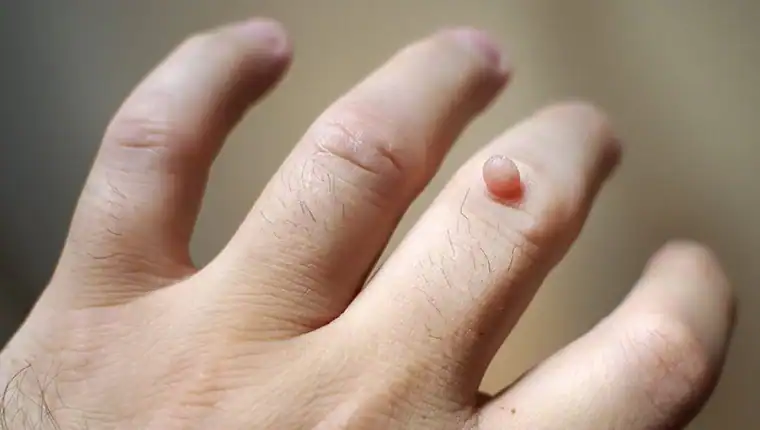Image of blemish that Cryotherapy Horsham can remove with Lipo 360.