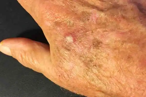 Image of Actinic keratoses Horsham on a person hand