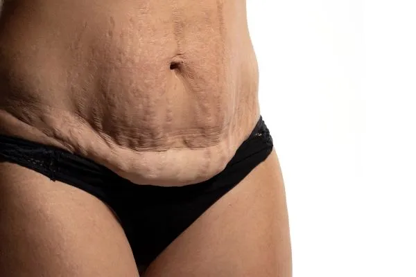 The science behind skin tightening Horsham picture of a woman's sagging skin on the stomach